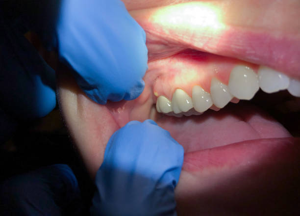 Best Emergency Denture Repair in Hurlock, MD